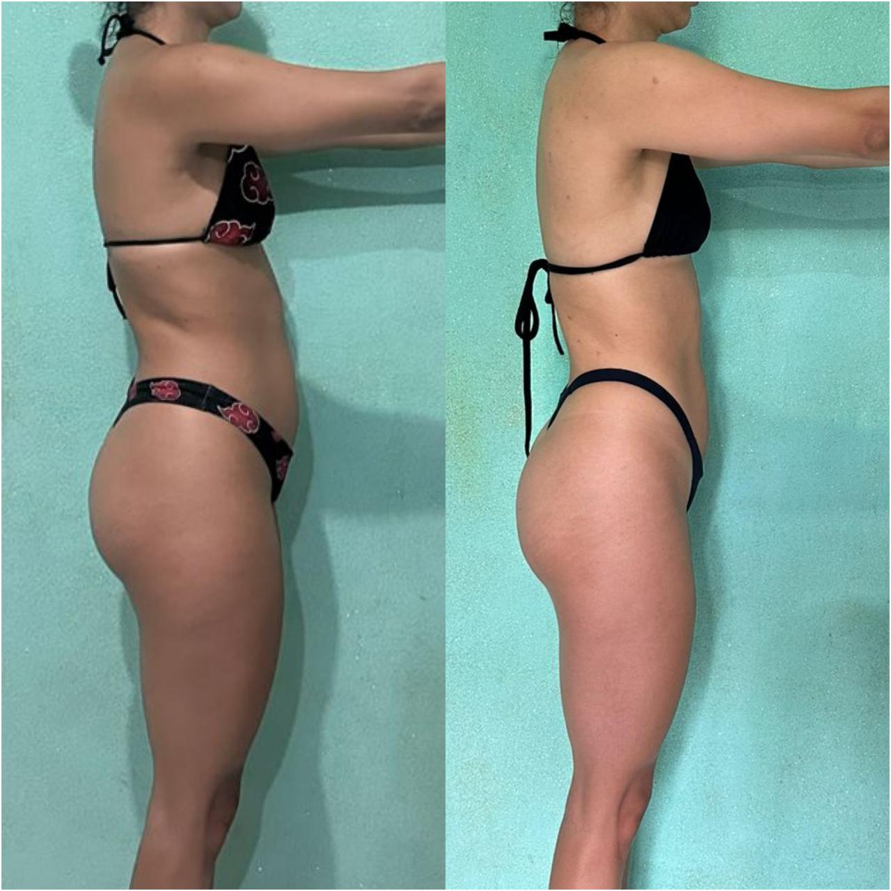 Resultado antes e depois de aluna DFTEAM, foto 26